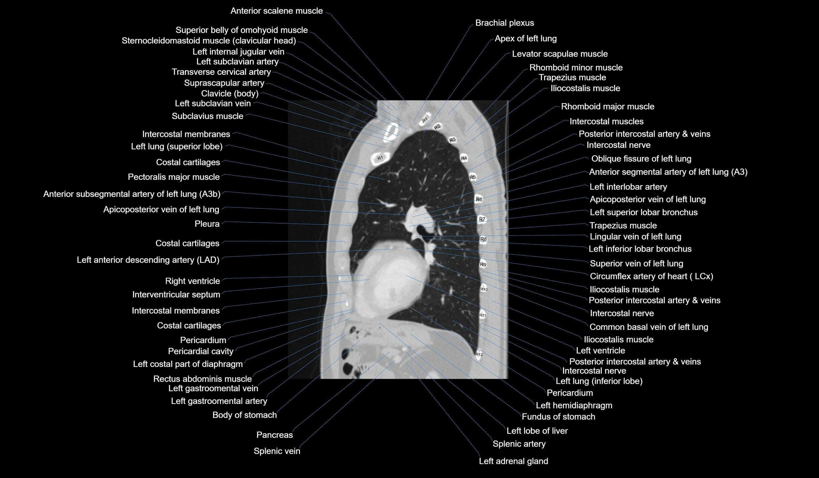 CT chest (thorax) labelled sagittal cross sectional anatomy radiology image-00092.webp